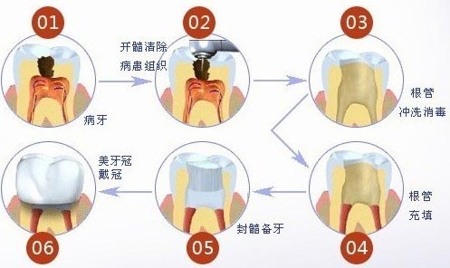重度牙髓炎根管治疗手术过程