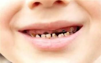 孩子牙齿龋坏要及时治疗
