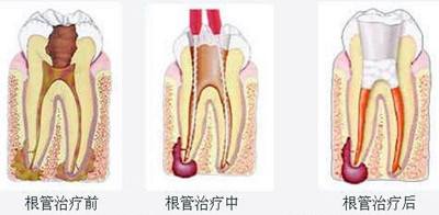 根尖周炎治疗前后对比图