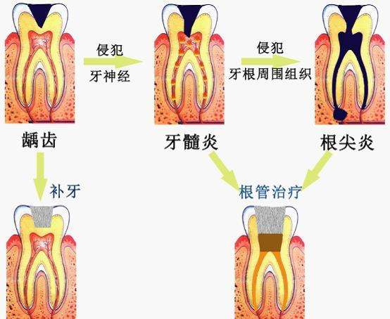根尖周炎发展过程及治疗方法