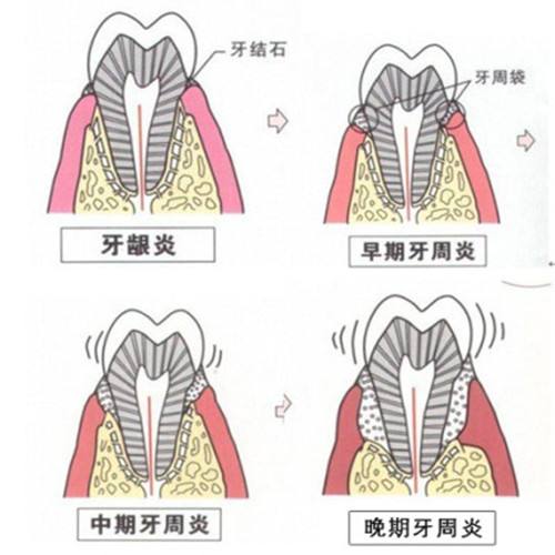 牙周炎的发展过程示意图