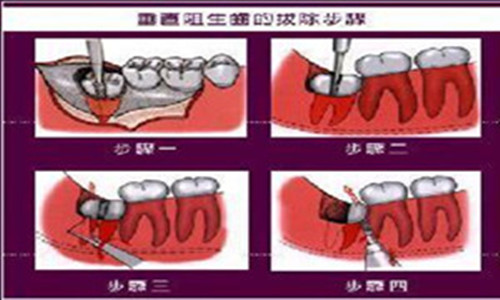 拔阻生齿