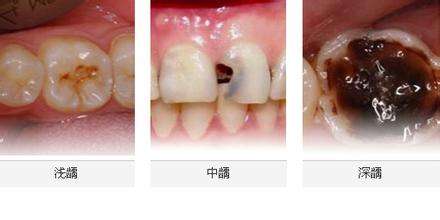龋齿不及时治疗的危害