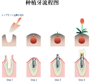 种植牙
