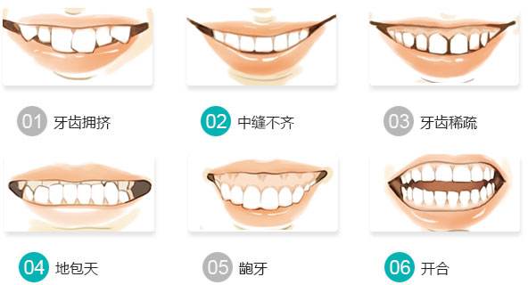 牙齿稀疏与其它牙齿畸形的区别