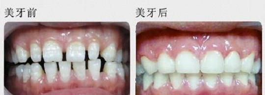 牙齿稀疏修复前后对比案例