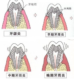 牙周病出现时的症状