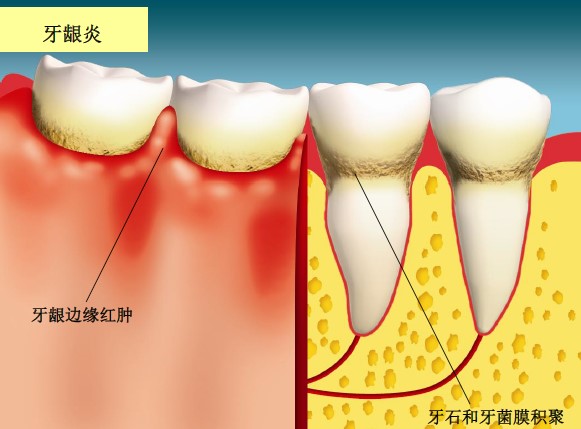 牙龈炎患者牙龈组织红肿发炎