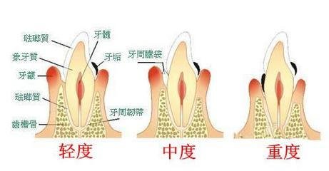 苏州严重牙周炎会有哪些并发症