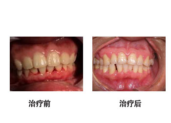 牙龈出血