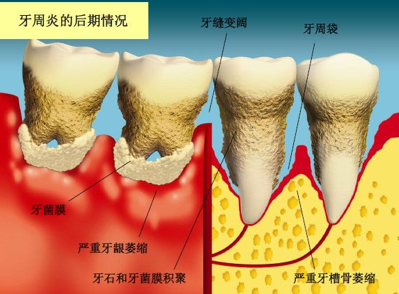 牙周炎的后期情况