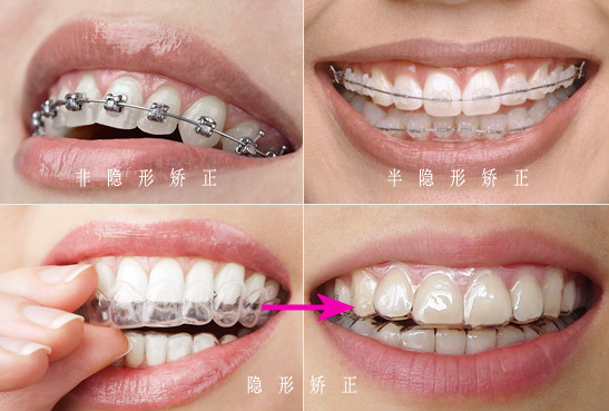 牙齿矫正的三种方法
