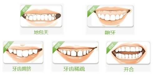 牙齿拥挤及常见牙齿畸形症状图