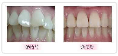 龅牙矫正前后对比