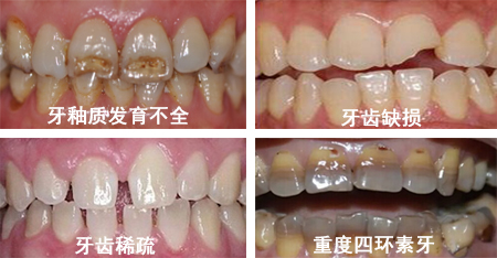 适合做全瓷牙的情况.jpg