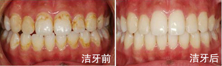 洁牙