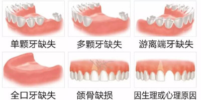 牙齿缺失症状