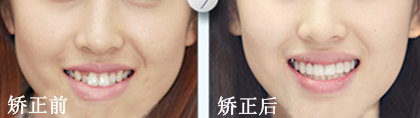 牙齿矫正案例1.jpg