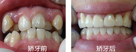 牙齿矫正案例