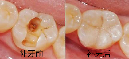 补牙案例