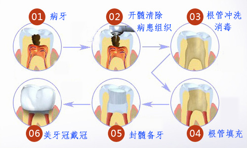 根管治疗步骤500.jpg