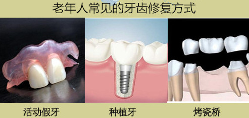 牙缺失修复方式_副本_副本.jpg
