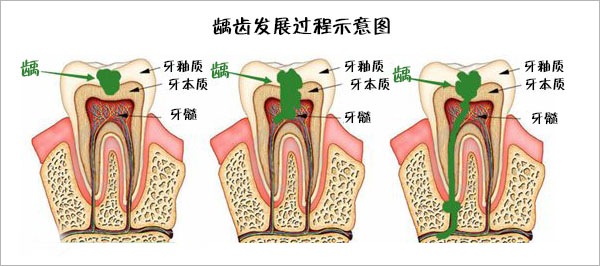 龋齿发展过程示意图1.jpg