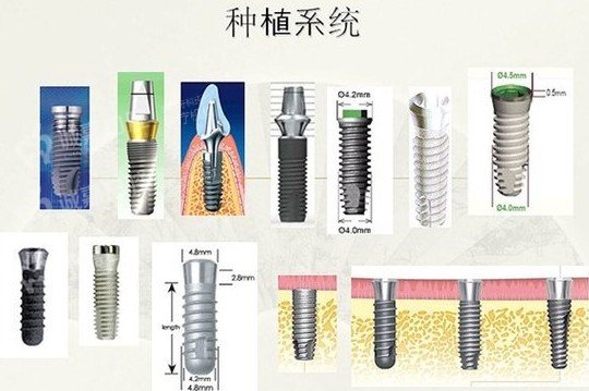 玛蒂娜种植体多少钱一颗