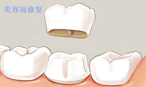 美容冠