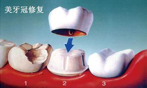 美容冠修复