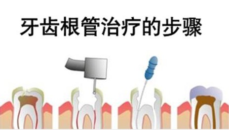 牙齿根管治疗的步骤