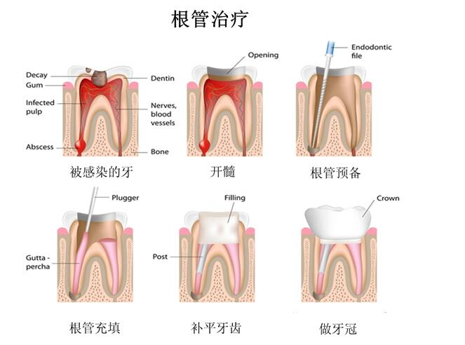 根管治疗.jpg