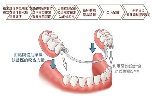 活动义齿制作过程