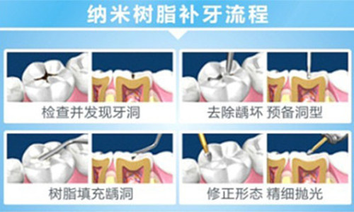 补牙