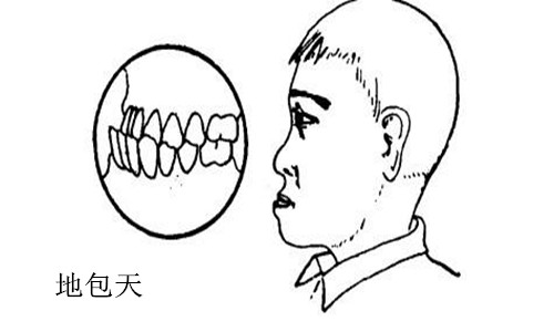地包天矫正