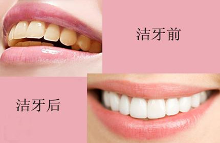 洗牙前后对比