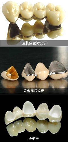 　　烤瓷牙修复