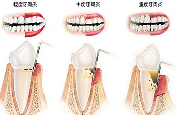 牙周病
