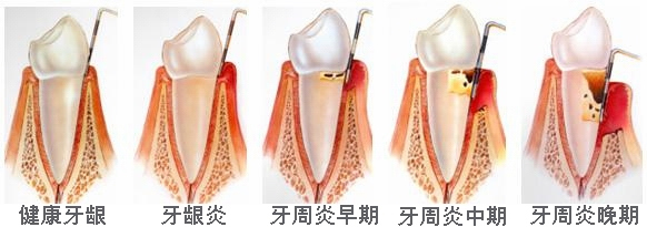 牙疼