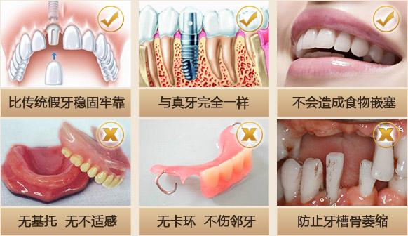 假牙