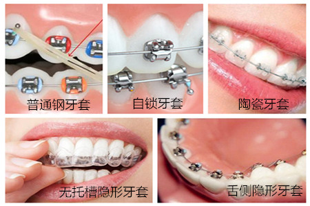 牙齿畸形可以矫正治疗