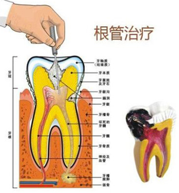 根管治疗