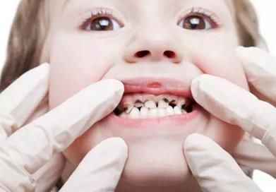 　　龋齿要尽早治疗