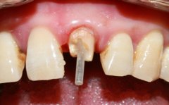 麦芽门牙做桩核冠