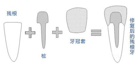 麦芽桩核冠原理