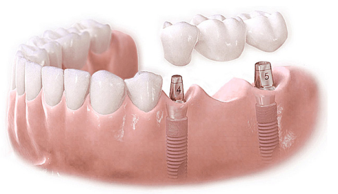 种植牙