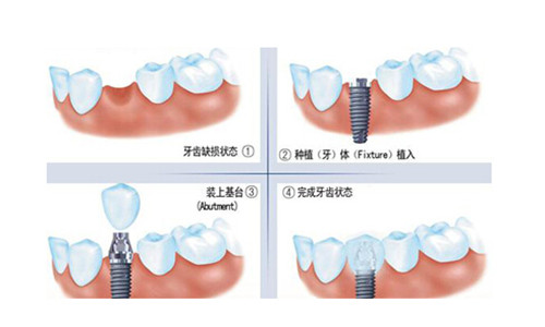 　　种植牙
