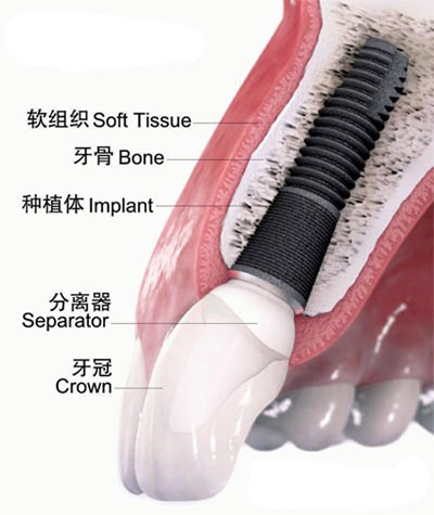 　　种植牙