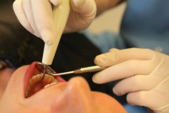 深圳拔智齿需要多少钱