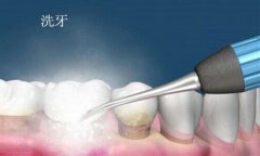 深圳超声波洗牙后要怎么护理